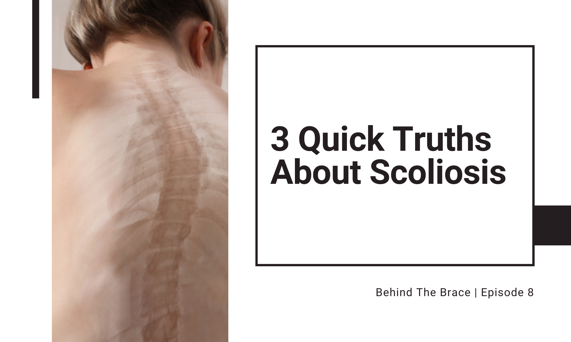 3 Quick Truths About Scoliosis