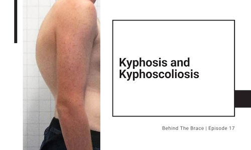 Kyphosis and Kyphoscoliosis